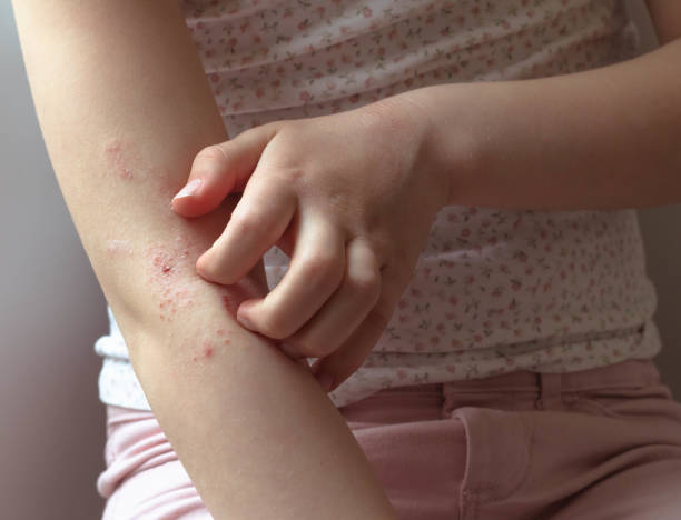 Quel savon pour l’eczéma chez un enfant ?